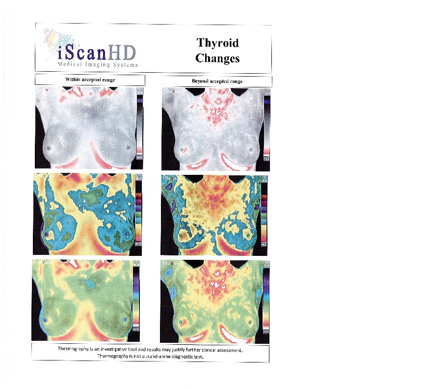 Thermography -- Thyroid Changes